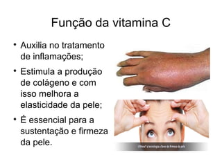 Função da vitamina C

Auxilia no tratamento
de inflamações;

Estimula a produção
de colágeno e com
isso melhora a
elasticidade da pele;

É essencial para a
sustentação e firmeza
da pele.
 