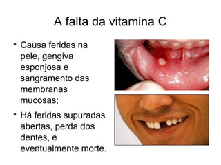 A falta da vitamina C

Causa feridas na
pele, gengiva
esponjosa e
sangramento das
membranas
mucosas;

Há feridas supuradas
abertas, perda dos
dentes, e
eventualmente morte.
 