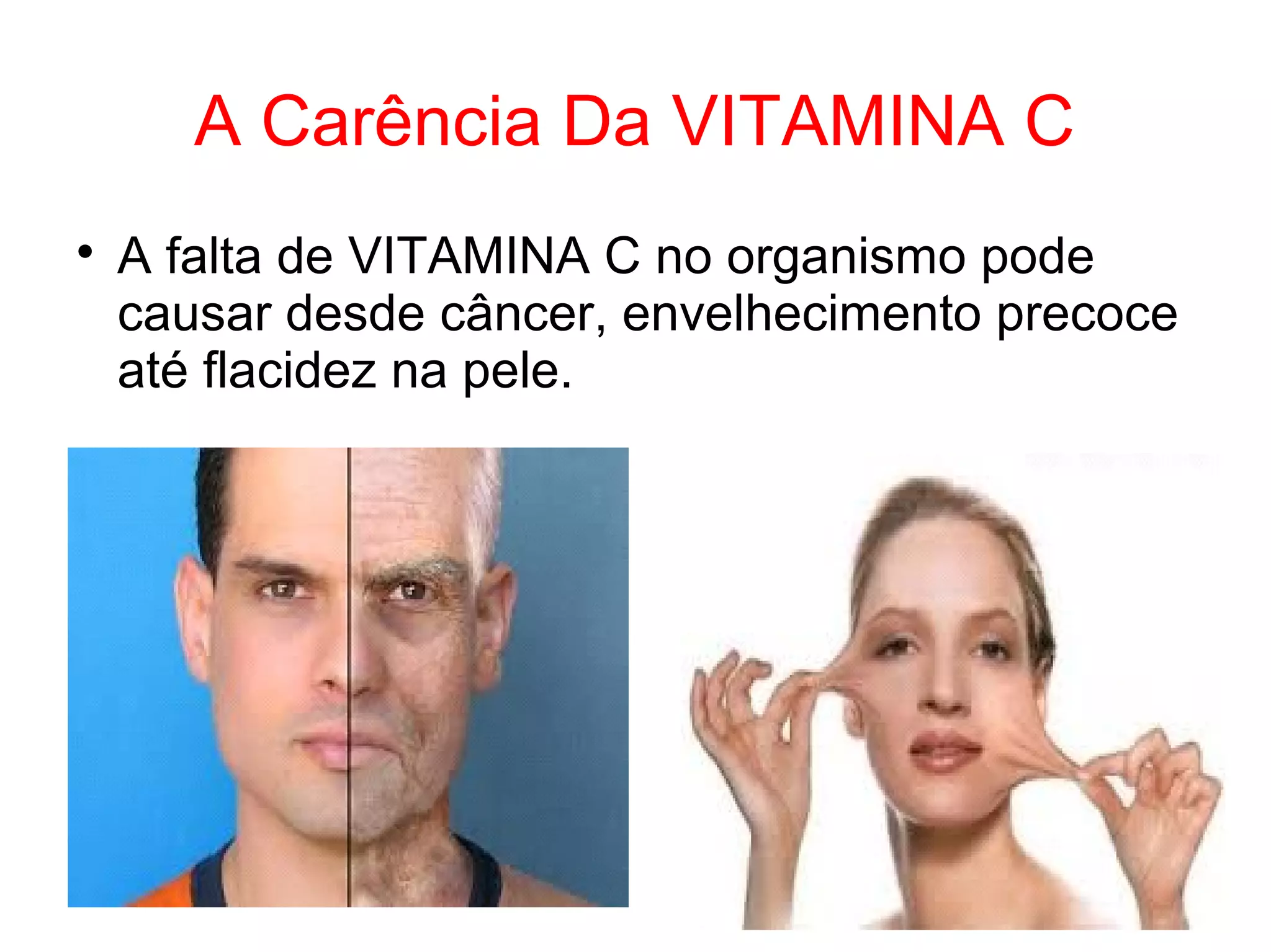 A Carência Da VITAMINA C

A falta de VITAMINA C no organismo pode
causar desde câncer, envelhecimento precoce
até flacidez na pele.
 