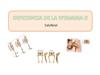Calciferol
 