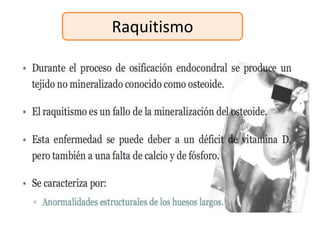 Raquitismo
 