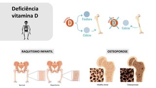 Deficiência
vitamina D
RAQUITISMO INFANTIL OSTEOPOROSE
Normal Raquitismo
 