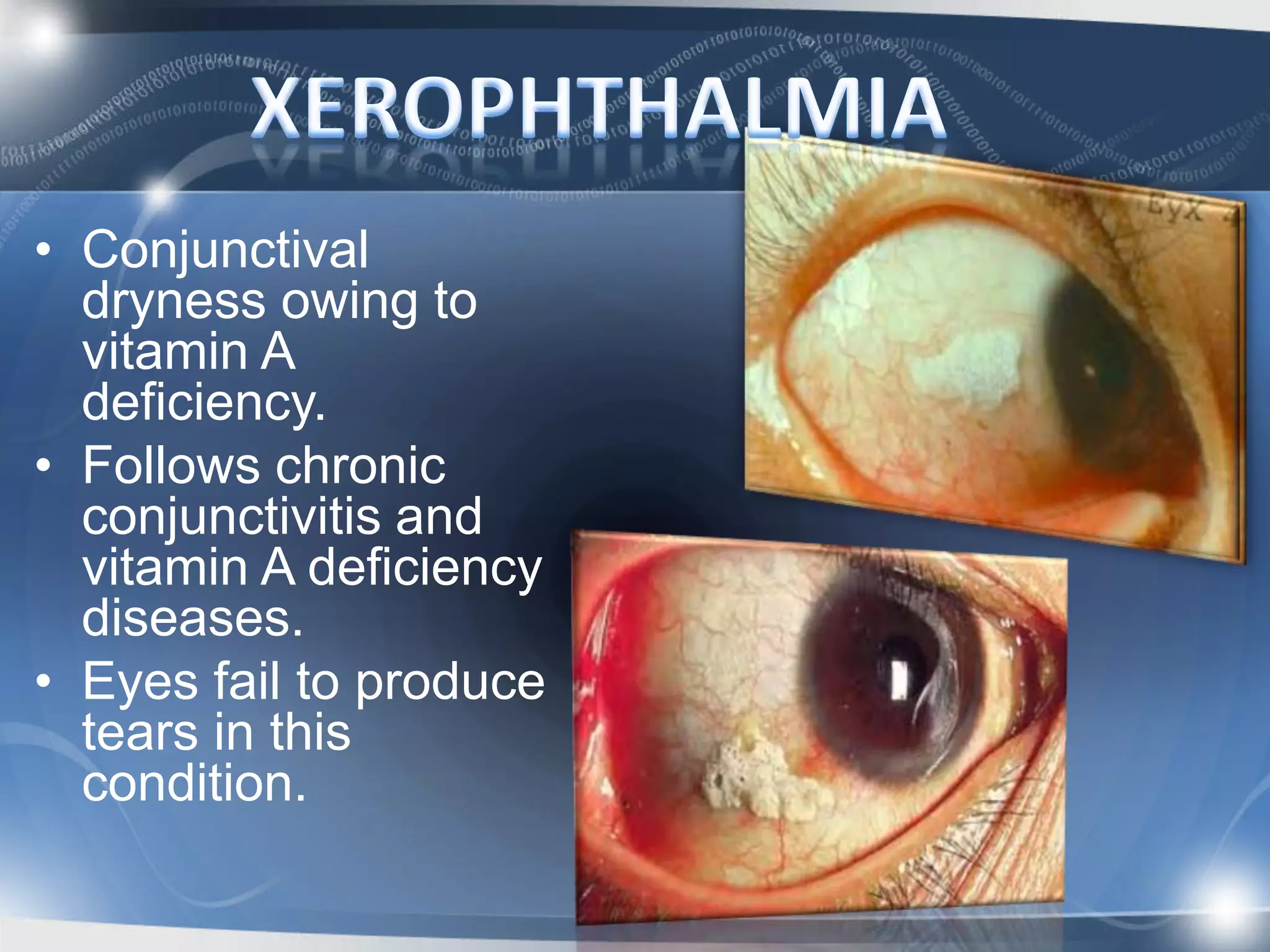 Vitamin A deficiency and its impact on vision | PPTX