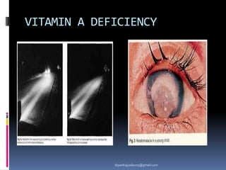 VITAMIN A DEFICIENCY
drpankajyadav05@gmail.com
 