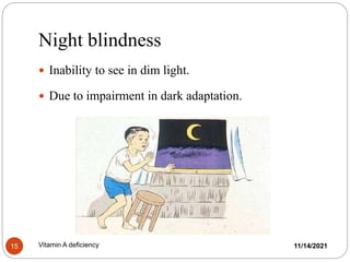 Night blindness
 Inability to see in dim light.
 Due to impairment in dark adaptation.
11/14/2021
15 Vitamin A deficiency
 