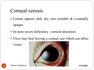 Corneal xerosis
11/14/2021
Vitamin A deficiency
18
 Cornea appears dull, dry, non wettable & eventually
opaque.
 In more severe deficiency - corneal ulceration.
 Ulcer may heal leaving a corneal scar which can affect
vision.
 