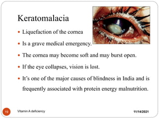 Keratomalacia
11/14/2021
Vitamin A deficiency
19
 Liquefaction of the cornea
 Is a grave medical emergency.
 The cornea may become soft and may burst open.
 If the eye collapses, vision is lost.
 It’s one of the major causes of blindness in India and is
frequently associated with protein energy malnutrition.
 