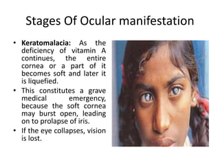 Stages Of Ocular manifestation
• Keratomalacia: As the
deficiency of vitamin A
continues, the entire
cornea or a part of it
becomes soft and later it
is liquefied.
• This constitutes a grave
medical emergency,
because the soft cornea
may burst open, leading
on to prolapse of iris.
• If the eye collapses, vision
is lost.
 
