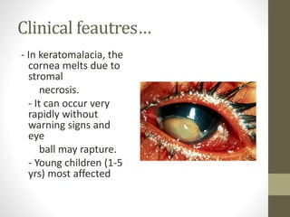 Clinical feautres…
- In keratomalacia, the
cornea melts due to
stromal
necrosis.
- It can occur very
rapidly without
warning signs and
eye
ball may rapture.
- Young children (1-5
yrs) most affected
 