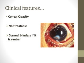 Clinical features…
• Coneal Opacity
Not treatable
Corneal blindess if it
is central
 