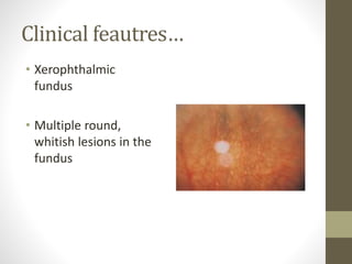 Clinical feautres…
• Xerophthalmic
fundus
• Multiple round,
whitish lesions in the
fundus
 