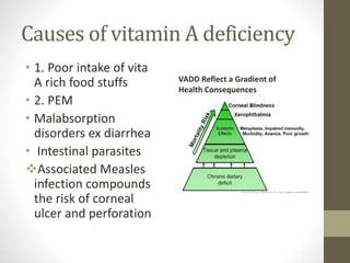 Causes of vitamin A deficiency
• 1. Poor intake of vita
A rich food stuffs
• 2. PEM
• Malabsorption
disorders ex diarrhea
• Intestinal parasites
Associated Measles
infection compounds
the risk of corneal
ulcer and perforation
VADD Reflect a Gradient of
Health Consequences
 