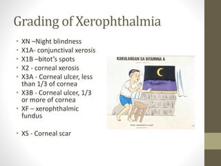 Grading of Xerophthalmia
• XN –Night blindness
• X1A- conjunctival xerosis
• X1B –bitot’s spots
• X2 - corneal xerosis
• X3A - Corneal ulcer, less
than 1/3 of cornea
• X3B - Corneal ulcer, 1/3
or more of cornea
• XF – xerophthalmic
fundus
• XS - Corneal scar
 