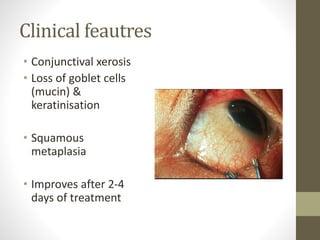 Clinical feautres
• Conjunctival xerosis
• Loss of goblet cells
(mucin) &
keratinisation
• Squamous
metaplasia
• Improves after 2-4
days of treatment
 