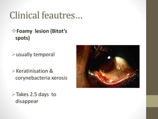 Clinical feautres…
Foamy lesion (Bitot’s
spots)
usually temporal
Keratinisation &
corynebacteria xerosis
Takes 2.5 days to
disappear
 