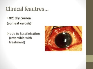 Clinical feautres…
• X2: dry cornea
(corneal xerosis)
due to keratinisation
(reversible with
treatment)
 