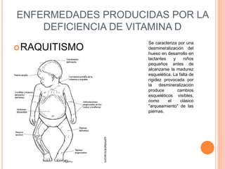 ENFERMEDADES PRODUCIDAS POR LA
DEFICIENCIA DE VITAMINA D
RAQUITISMO
Se caracteriza por una
desmineralización del
hueso en desarrollo en
lactantes y niños
pequeños antes de
alcanzarse la madurez
esquelética. La falta de
rigidez provocada por
la desmineralización
produce cambios
esqueléticos visibles,
como el clásico
"arqueamiento" de las
piernas.
 