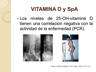 VITAMINA D y SpA
   Los niveles de 25-OH-vitamina D
    tienen una correlación negativa con la
    actividad de la enfermedad (PCR).
 