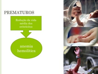 PREMATUROS
anemia
hemolítica
Redução da vida
média dos
eritrócitos
 