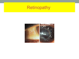 Retinopathy
 
