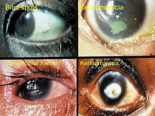 Bitot spots Keratomalacia
Conjunctival Xerosis Keratomalacia
 
