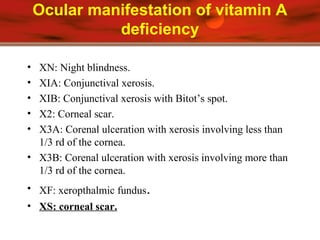 Ocular manifestation of vitamin A
deficiency
• XN: Night blindness.
• XIA: Conjunctival xerosis.
• XIB: Conjunctival xerosis with Bitot’s spot.
• X2: Corneal scar.
• X3A: Corenal ulceration with xerosis involving less than
1/3 rd of the cornea.
• X3B: Corenal ulceration with xerosis involving more than
1/3 rd of the cornea.
• XF: xeropthalmic fundus.
• XS: corneal scar.
 