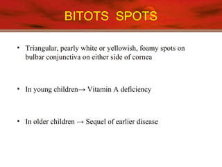 BITOTS SPOTS
• Triangular, pearly white or yellowish, foamy spots on
bulbar conjunctiva on either side of cornea
• In young children→ Vitamin A deficiency
• In older children → Sequel of earlier disease
 