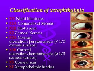 Classification of xerophthalmia
• XN Night blindness
• X1A Conjunctival Xerosis
• X1B Bitot’s spot
• X2 Corneal Xerosis
• X3A Corneal
ulceration/keratomalacia (< 1/3
corneal surface)
• X3B Corneal
ulceration/keratomalacia (≥ 1/3
corneal surface)
• XS Corneal scar
• XF Xerophthalmic fundus

 