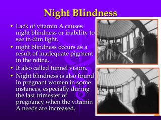 Night Blindness
• Lack of vitamin A causes
night blindness or inability to
see in dim light.
• night blindness occurs as a
result of inadequate pigment
in the retina.
• It also called tunnel vision.
• Night blindness is also found
in pregnant women in some
instances, especially during
the last trimester of
pregnancy when the vitamin
A needs are increased.

 