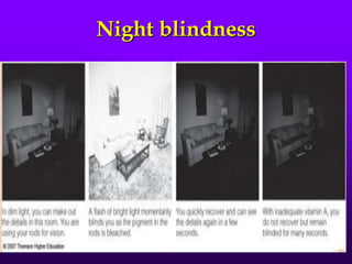 Night blindness

 