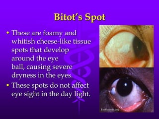 Bitot’s Spot
• These are foamy and
whitish cheese-like tissue
spots that develop
around the eye
ball, causing severe
dryness in the eyes.
• These spots do not affect
eye sight in the day light.

 
