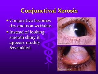 Conjunctival Xerosis
• Conjunctiva becomes
dry and non wettable.
• Instead of looking
smooth shiny it
appears muddy
&wrinkled.

 