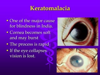 Keratomalacia
• One of the major cause
for blindness in India.
• Cornea becomes soft
and may burst
• The process is rapid
• If the eye collapses
vision is lost.

 