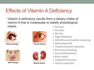 Vitamin A Deficiency Blindness