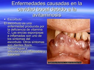 Enfermedades causadas en la cavidad bucal debido a la avitaminosis Escorbuto  El escorbuto es una enfermedad producida por la deficiencia de vitamina C. Las encías esponjosas e inflamadas son uno de los síntomas del escorbuto. Otros síntomas son dientes flojos, hemorragias y articulaciones inflamadas y dolorosa. 