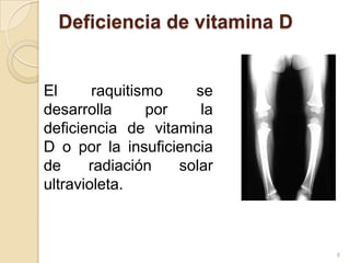 Deficiencia de vitamina D 	El raquitismo se desarrolla por la deficiencia de vitamina D o por la insuficiencia de radiación solar ultravioleta. 8