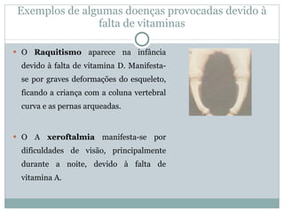 O  Raquitismo  aparece na infância devido à falta de vitamina D. Manifesta-se por graves deformações do esqueleto, ficando a criança com a coluna vertebral curva e as pernas arqueadas.  O A  xeroftalmia  manifesta-se por dificuldades de visão, principalmente durante a noite, devido à falta de vitamina A. Exemplos de algumas doenças provocadas devido à falta de vitaminas 