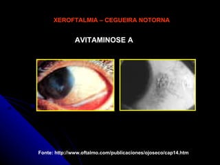 XEROFTALMIA – CEGUEIRA NOTORNA Fonte: http://www.oftalmo.com/publicaciones/ojoseco/cap14.htm AVITAMINOSE A 
