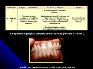 Sangramento gengival causado pelo escorbuto (falta de vitamina C) FONTE: http://www.nutriweb.org.br/n0201/hipovitaminoses.htm VITAMINAS FUNÇÕES / IMPORTÂNCIA CARÊNCIA / EXCESSO FONTES VITAMINA C Principais funções: participa na formação de catecolaminas; aumenta a absorção de ferro pelo intestino.   Manifestações de carência da vitamina C.  Lesões do colágeno. O escorbuto era típico dos marinheiros que enfrentavam longas viagens. É, hoje em dia, uma doença praticamente desconhecida.  Manifestações de excesso: Formação de cálculos nos rins.   Principais fontes: frutas e verduras frescas.   