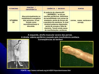 A esquerda, atrofia muscular severa das pernas.   A direita: edema periférico causado pela insuficiência cardíaca.  Conseqüências do beriberi  FONTE: http://www.nutriweb.org.br/n0201/hipovitaminoses.htm VITAMINAS FUNÇÕES / IMPORTÂNCIA CARÊNCIA / EXCESSO FONTES VITAMINA B1 Atua principalmente no metabolismo energético dos açúcares. A sua função como neurotransmissor é discutida.  A carência de vitamina B1  ( BERIBÉRI )  se dá por neurites periféricas, distúrbios da sensibilidade com zonas de anestesia, perda de forças até a paralisia de membros. A nível cerebral podemos depressão, perda de energia e falta de memória. Temos ainda casos de manifestações cardíacas. carnes,  nozes, verduras e cerveja.  
