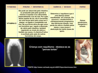 Criança com raquitismo - destaca-se as &quot;pernas tortas&quot; FONTE:http://www.nutriweb.org.br/n0201/hipovitaminoses.ht...
