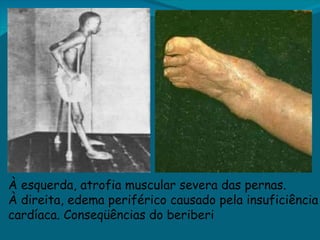 À esquerda, atrofia muscular severa das pernas.   À direita, edema periférico causado pela insuficiência cardíaca. Conseqüências do beriberi 