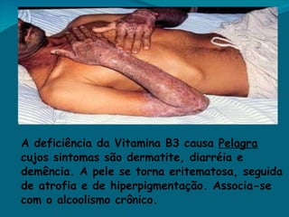 A deficiência da Vitamina B3 causa  Pelagra  cujos sintomas são dermatite, diarréia e demência. A pele se torna eritematosa, seguida de atrofia e de hiperpigmentação. Associa-se com o alcoolismo crônico. 
