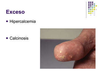 Exceso Hipercalcemia Calcinosis 