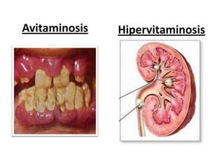 Avitaminosis   Hipervitaminosis
 