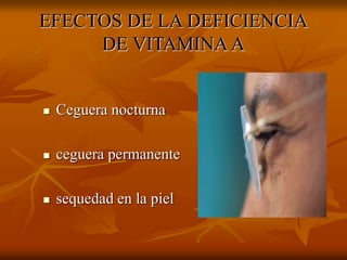 EFECTOS DE LA DEFICIENCIA
DE VITAMINA A
 Ceguera nocturna
 ceguera permanente
 sequedad en la piel
 
