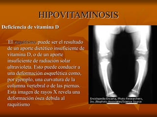 HIPOVITAMINOSIS
Deficiencia de vitamina D
El raquitismo puede ser el resultado
de un aporte dietético insuficiente de
vitamina D, o de un aporte
insuficiente de radiación solar
ultravioleta. Esto puede conducir a
una deformación esquelética como,
por ejemplo, una curvatura de la
columna vertebral o de las piernas.
Esta imagen de rayos X revela una
deformación ósea debida al
raquitismo
 