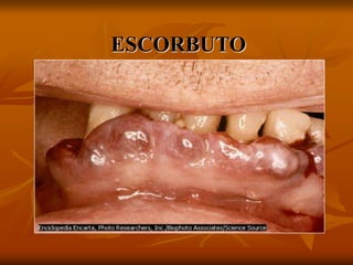 ESCORBUTO
 