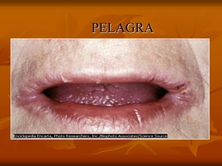 PELAGRA
 