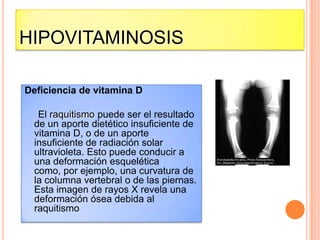 HIPOVITAMINOSIS
Deficiencia de vitamina D
El raquitismo puede ser el resultado
de un aporte dietético insuficiente de
vitamina D, o de un aporte
insuficiente de radiación solar
ultravioleta. Esto puede conducir a
una deformación esquelética
como, por ejemplo, una curvatura de
la columna vertebral o de las piernas.
Esta imagen de rayos X revela una
deformación ósea debida al
raquitismo

 